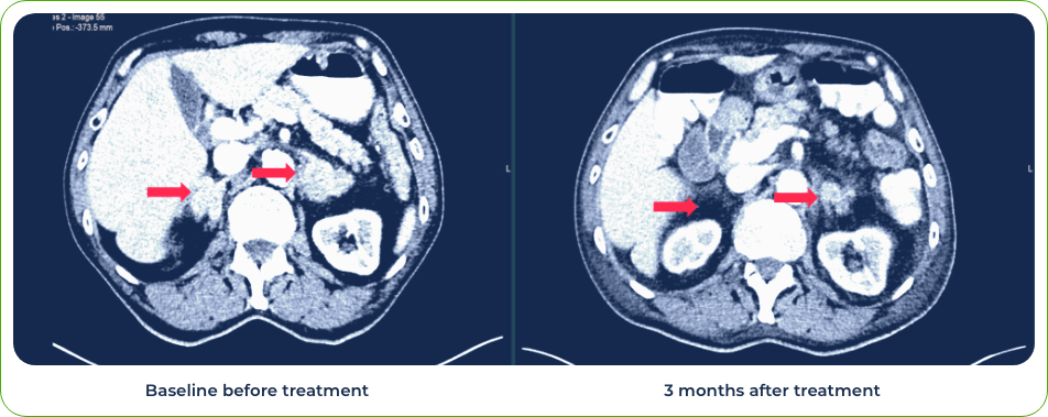 Case 1: 75-year-old male treated with gotistobart